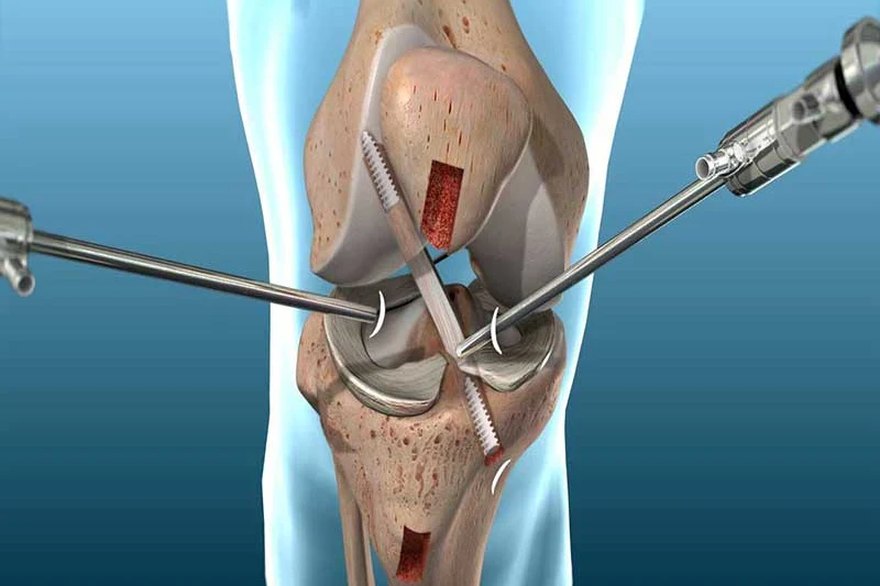 Dr. Arvind Sharma – Orthopaedic Surgeon Delhi